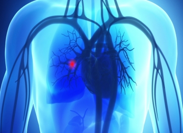 Pulmonary Embolism