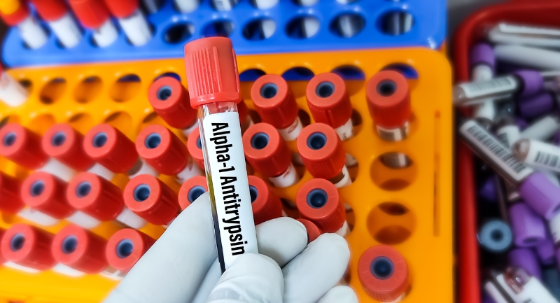 Alpha-1 Antitrypsin Deficiency Blood Test
