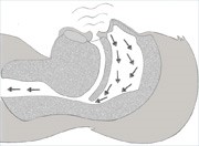 Partially Blocked Airway