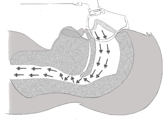 cpap diagram