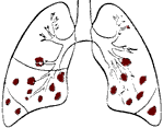 Bronchial Pneumonia