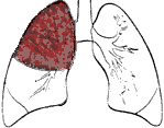 lobar pneumonia